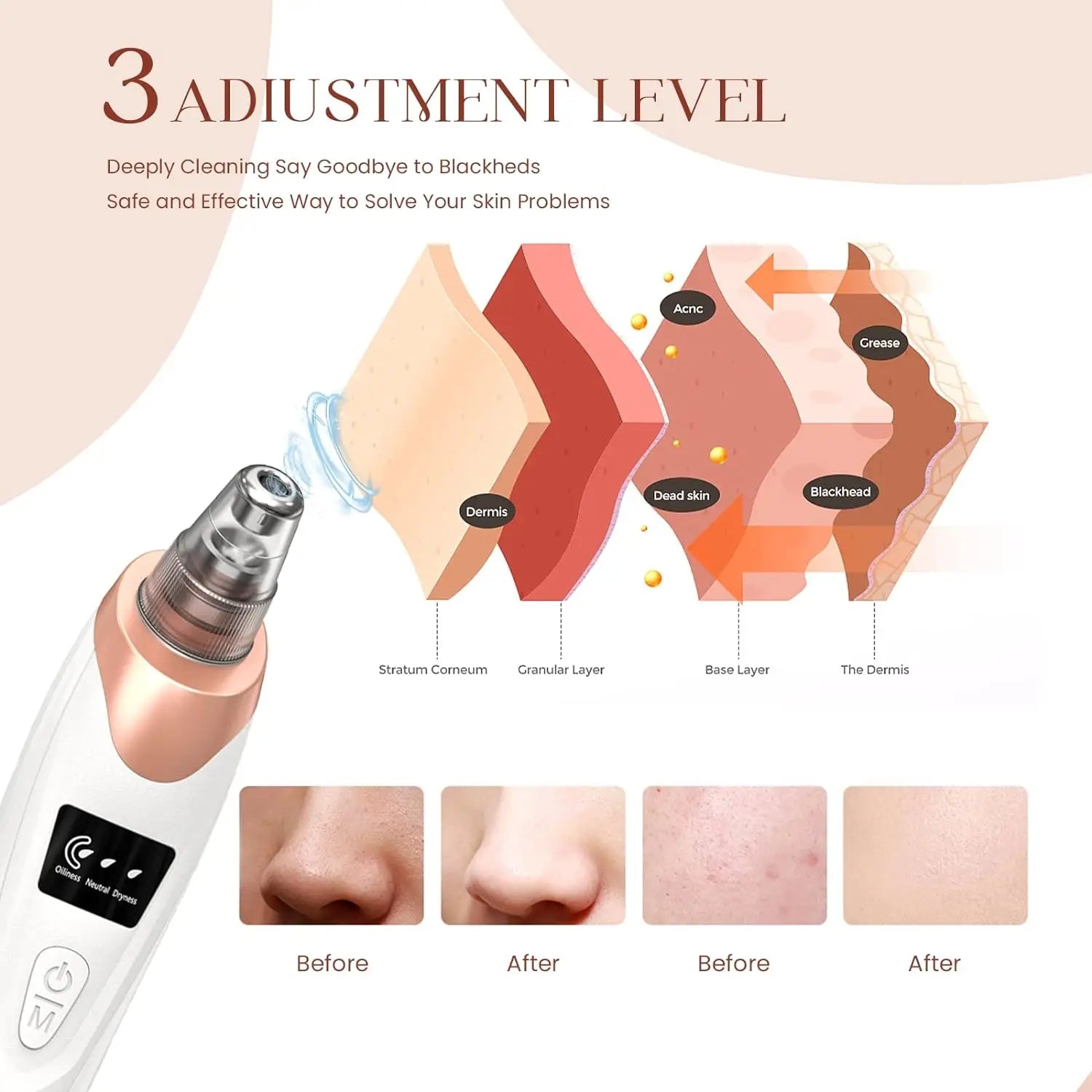 Pro Blackhead Vacuum – Deep Clean, Pore Perfect