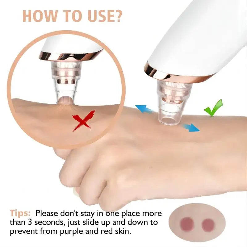 Pro Blackhead Vacuum – Deep Clean, Pore Perfect